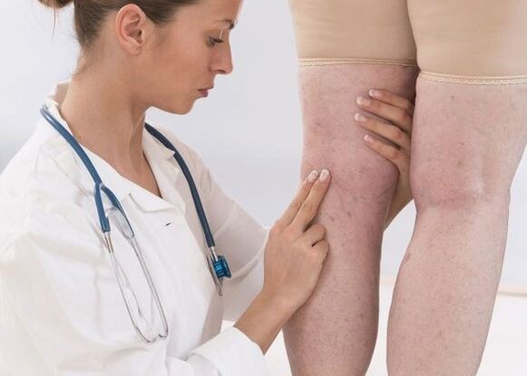 A varikoosák diagnosztizálása