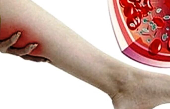 Varikózis erek a lábon
