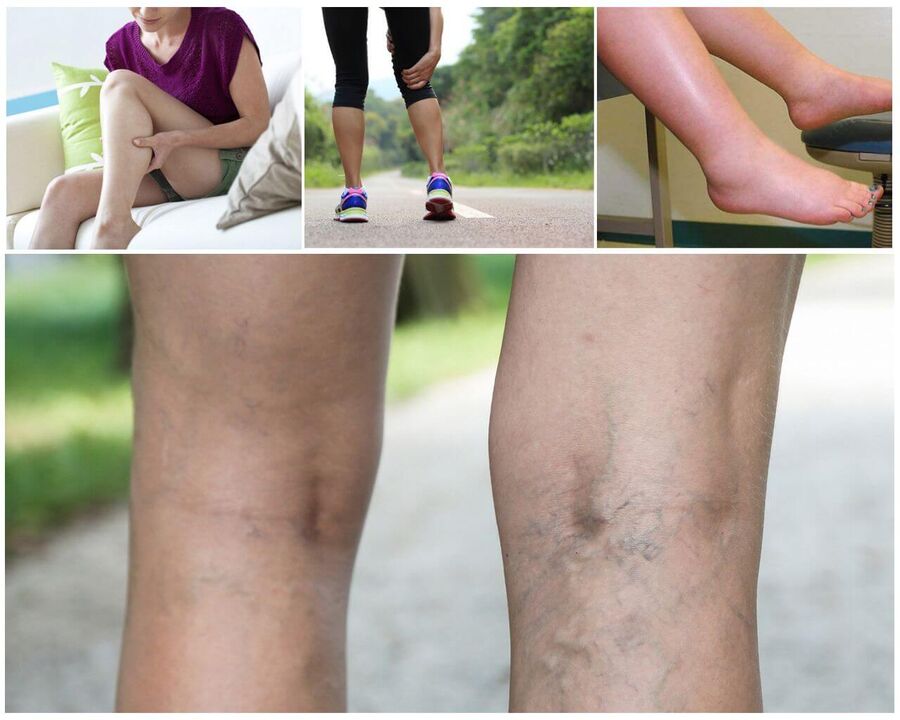 Varicosis kezdete