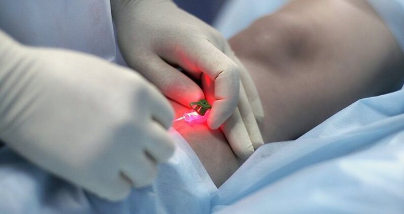 Visszér sebészeti kezelése