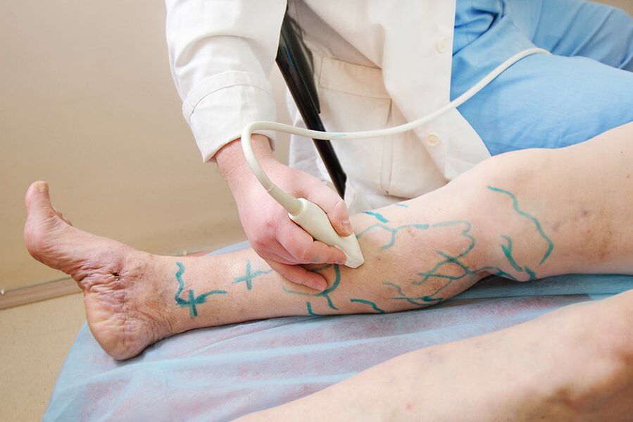 Miniphlebectomia előkészítése - a láb perforátorainak megjelölése, ultrahangos vizsgálat